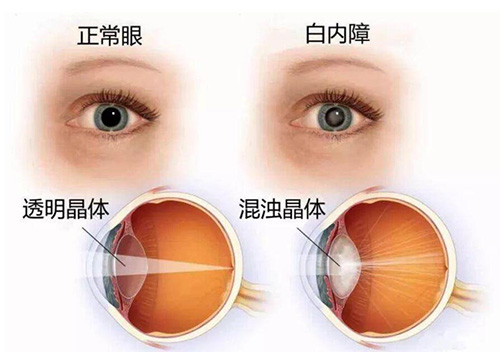 白内障和正常眼睛不同对比