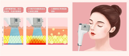 超声炮操作过程示意图