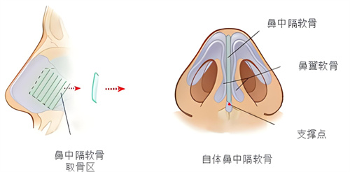 隆鼻鼻中隔软骨鼻