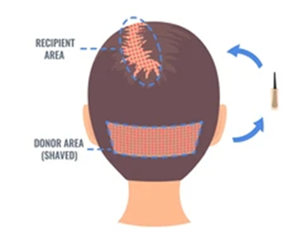 后枕毛囊移植过程图解