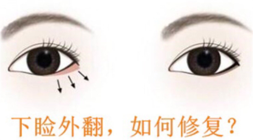 下眼睑外翻怎么办