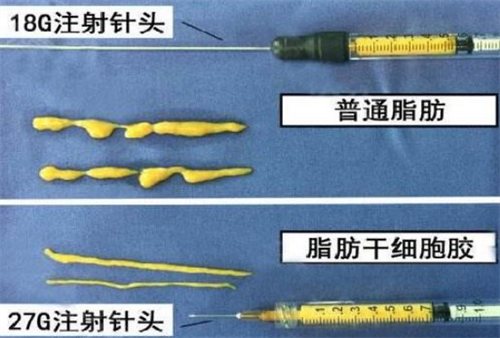 自体脂肪填充需要的脂肪提纯后的样子图片