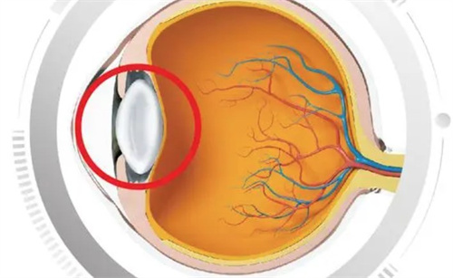 白内障的眼球