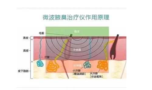 miradry微波治疗原理