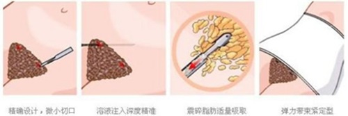 腹部吸脂示意图