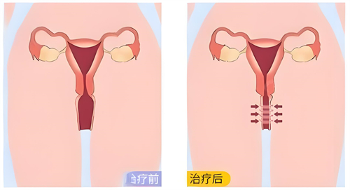 3D生物束带紧缩术真的有效吗？从手术原理/结果及优势来全方面分析