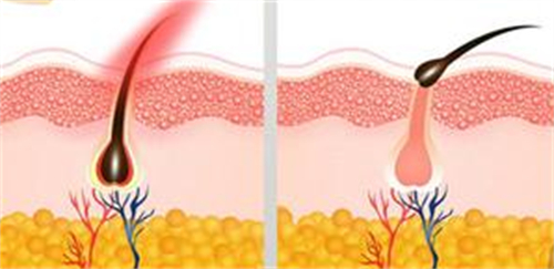 脱毛前后毛囊的变化