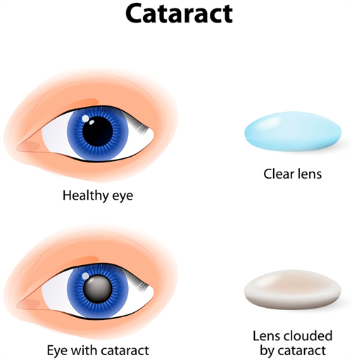 白内障眼睛和正常眼睛区别