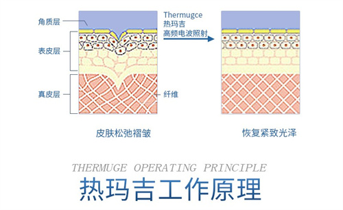 热玛吉工作示意图