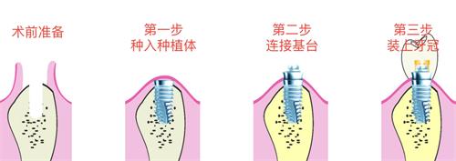 种植牙的步骤