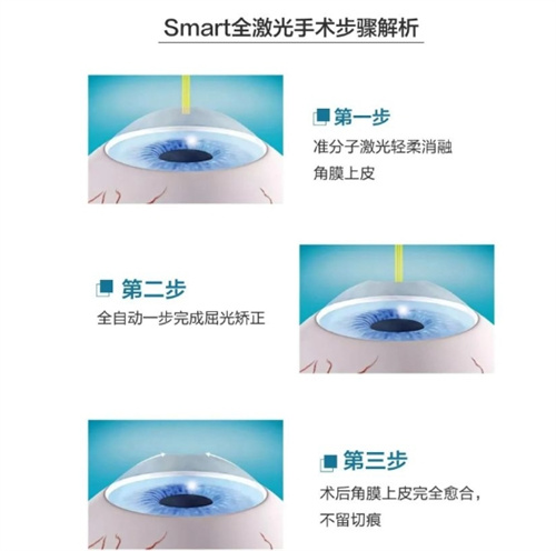 全激光smart手术步骤