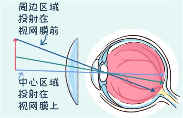 离焦软镜矫正原理图解