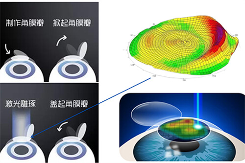 激光近视手术过程示意图