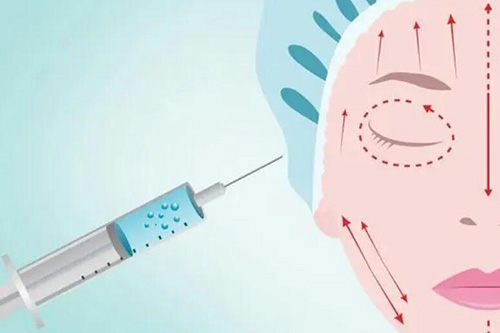 面部玻尿酸注射照片