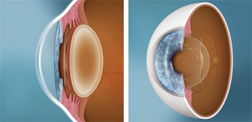 人工晶体植入眼睛对比 人工晶体植入眼睛对比