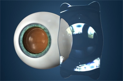 眼睛植入ICL晶体 眼睛植入ICL晶体