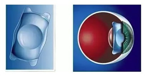 老花眼晶体置换手术 老花眼晶体置换手术