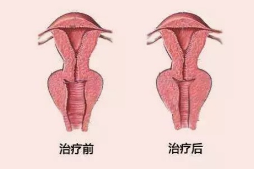 阴道紧缩针注射卡通图