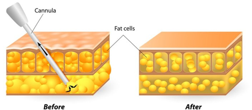 吸脂前后对比图示