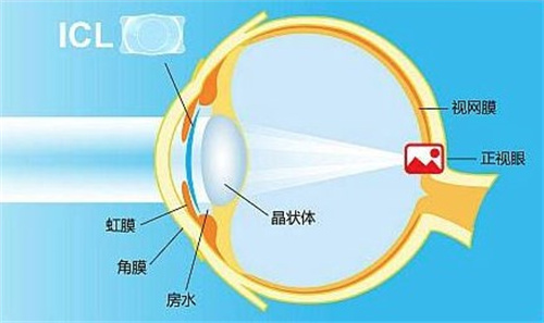 ICL晶体植入手术示意图
