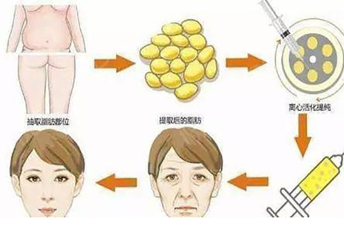 面部脂肪填充过程示意图