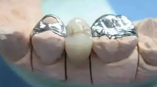 汕头奥诗卡口腔镶牙治疗细节图