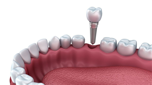 单颗种植体图示 单颗种植体图示
