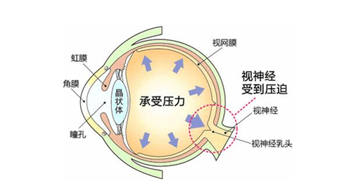 眼压高的因素分享展示