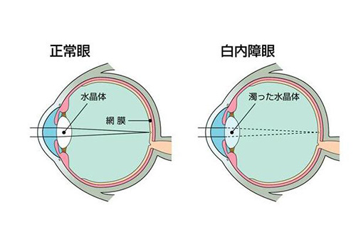 正常眼睛和白内障对比展示