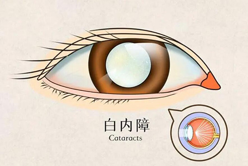 白内障卡通展示照片