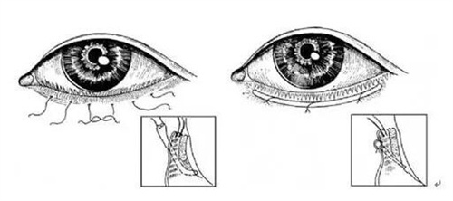 倒睫手术过程示意图