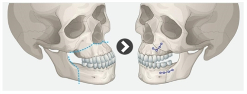 双颚手术的前后对比