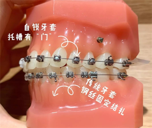 金属自锁牙套和传统牙套