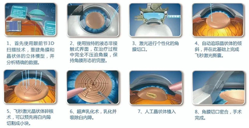 国内免费白内障治疗政策有哪些项目?手术费用免费,人工晶体减免!