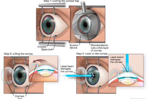近视手术操作过程图解