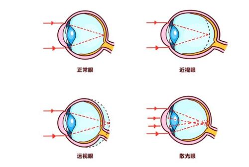 远视眼和近视眼的区别