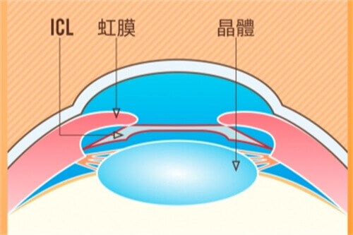 ICL示意图