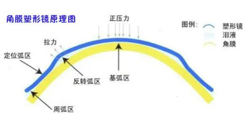 苏州光明眼科角膜塑形镜原理示意图