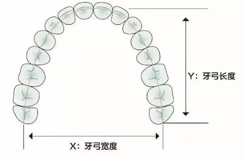 牙齿矫正扩牙弓示意图