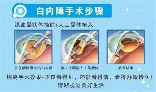 淮北2024年白内障免费政策详解，这些情况或可申请免费手术！