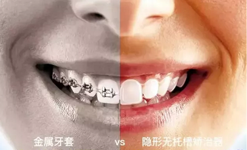 金属牙套vs隐形无托槽牙套