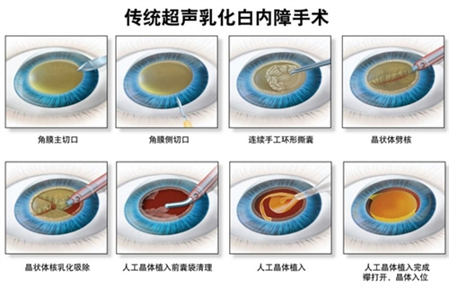 抚顺白内障手术免费政策查看，抚顺免费白内障手术申请条件/申请流程分享！