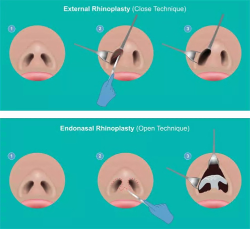 鼻整形过程图