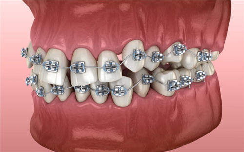 牙齿矫正口内动画示意图 牙齿矫正口内动画示意图