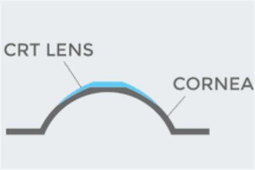 美国crt角膜塑形镜价格10700元起，价格稍贵但舒适度高/散光可用