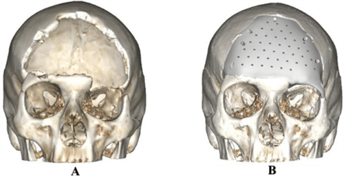 颅骨修补前后对比