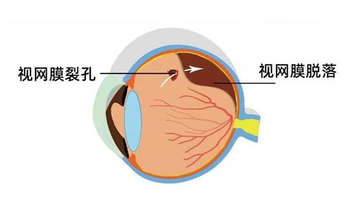 视网膜脱落手术费用要多少？外路手术8000+/内路手术15000+/复杂性视网膜脱落21000+