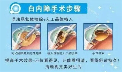 白内障手术示意图