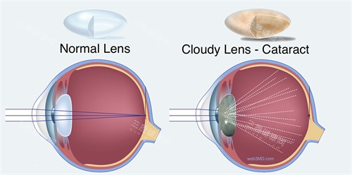 白内障图示