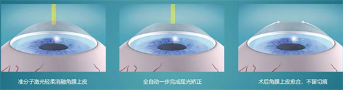 近视手术简要流程 近视手术简要流程